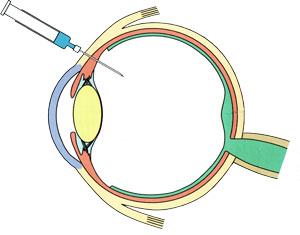 ルセンティス注射図
